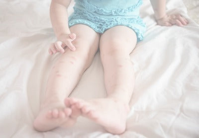 Treating Bug Bites On Babies: Fleas, Mosquitos, And Ants