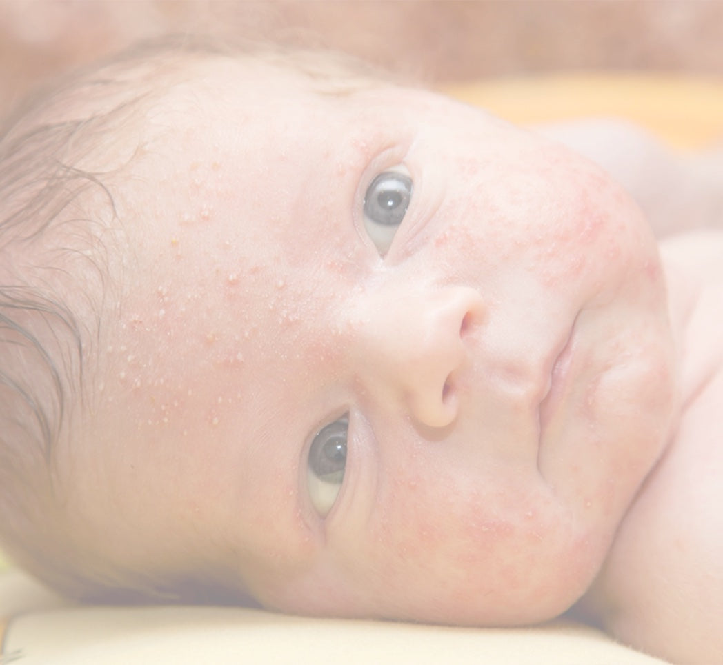 Newborn acne on face deals