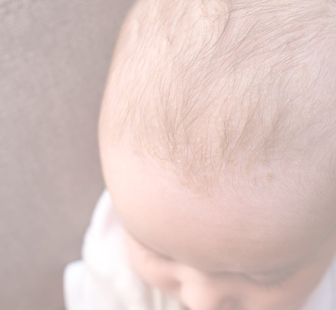 Cradle Cap On Your Baby's Face: Causes And Treatment