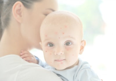 Baby Chicken Pox: The Complete Guide For Parents