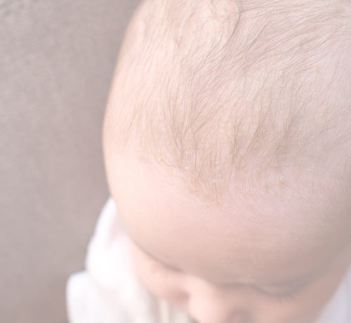 cradle cap on face - Mustela USA - 1