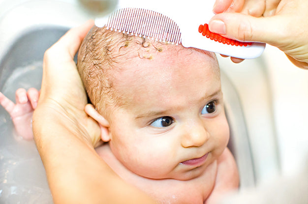 What Causes Cradle Cap In Babies? | A Guide For Parents
