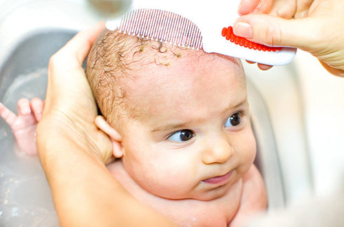 What Causes Cradle Cap In Babies? | A Guide For Parents - Mustela USA - 1