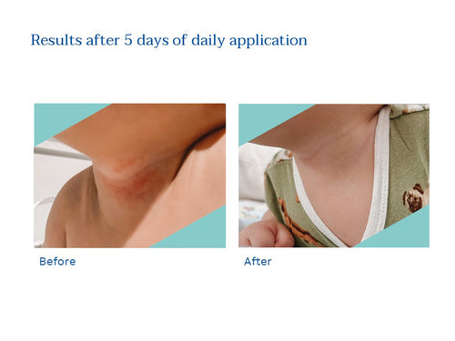Mustela USA | Stelatopia Intense Eczema Relief Before and After 5 days - Mustela USA - 3