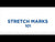 Video on Stretch Marks